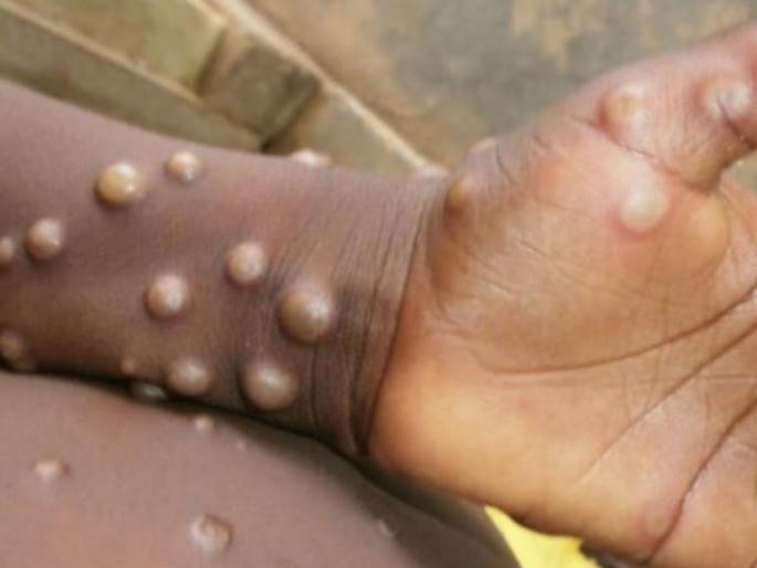 second positive case of Monkey Pox in Kerala has been confirmed | Monkeypox: अलर्ट! केरळमध्ये मंकीपॉक्सचा आणखी एक रुग्ण आढळला, कोणती काळजी घ्याल? second positive case of Monkey Pox in Kerala has been confirmed | Monkeypox: अलर्ट! केरळमध्ये मंकीपॉक्सचा आणखी एक रुग्ण आढळला, कोणती काळजी घ्याल?
