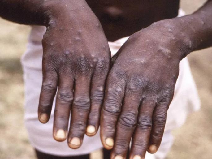 31 year old woman tests positive for monkeypox in delhi | मंकीपॉक्स हातपाय पसरू लागला, दिल्लीत चौथा रुग्ण आढळला; देशात एकूण ९ रुग्ण 31 year old woman tests positive for monkeypox in delhi | मंकीपॉक्स हातपाय पसरू लागला, दिल्लीत चौथा रुग्ण आढळला; देशात एकूण ९ रुग्ण
