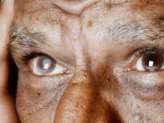 6 patients lose sight after cataract surgery CMo orders probe Incidents in Kanpur | मोतीबिंदूच्या ऑपरेशननंतर ६ रुग्णांची दृष्टीच गेली, मुख्यमंत्री कार्यालयाकडून चौकशीचे आदेश; कानपूरमधील घटना 6 patients lose sight after cataract surgery CMo orders probe Incidents in Kanpur | मोतीबिंदूच्या ऑपरेशननंतर ६ रुग्णांची दृष्टीच गेली, मुख्यमंत्री कार्यालयाकडून चौकशीचे आदेश; कानपूरमधील घटना