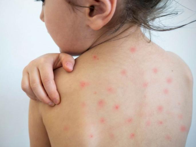 be careful increase in chicken pox patients 6 to 10 patients per day in nagpur | काळजी घ्या, कांजण्याच्या रुग्णांत वाढ, रोज ६ ते १० रुग्ण be careful increase in chicken pox patients 6 to 10 patients per day in nagpur | काळजी घ्या, कांजण्याच्या रुग्णांत वाढ, रोज ६ ते १० रुग्ण