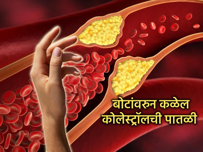 Health: Increased cholesterol in the body can be seen from two fingers of the hand; take 'this' remedy immediately | Health: हाताच्या दोन बोटांवरून लक्षात येतं, शरीरात वाढलेलं कोलेस्ट्रॉल; त्वरित करा 'हे' उपाय 