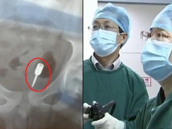 9 year old child inserts pointed dart arrow through anus while self pleasure | बोंबला! मजा म्हणून त्याने घरात कुणी नसताना केला 'हा' कारनामा, डॉक्टर एक्स-रे पाहून झालेत हैराण.... 9 year old child inserts pointed dart arrow through anus while self pleasure | बोंबला! मजा म्हणून त्याने घरात कुणी नसताना केला 'हा' कारनामा, डॉक्टर एक्स-रे पाहून झालेत हैराण....
