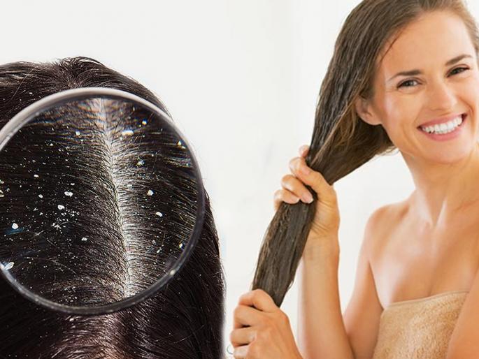 Know the home remedies to get rid of dandruff | 'या' घरगुती उपायांनी नेहमीसाठी दूर होईल डॅंड्रफची कटकट, जाणून घ्या काय आहे उपाय... Know the home remedies to get rid of dandruff | 'या' घरगुती उपायांनी नेहमीसाठी दूर होईल डॅंड्रफची कटकट, जाणून घ्या काय आहे उपाय...