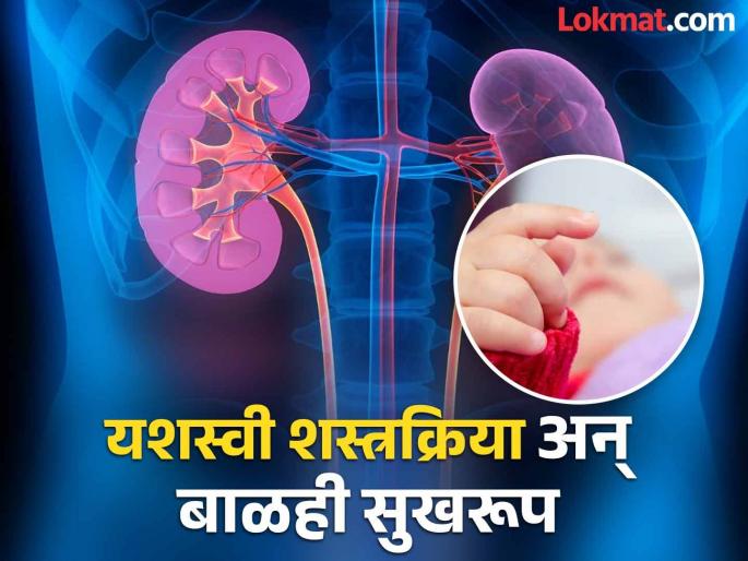 Four kidneys at birth Surgery on baby successful risk of infection also avoided | Pune: जन्मजात चार मूत्रपिंडे; बाळावरील शस्त्रक्रिया यशस्वी, संसर्गाचा धोकाही टळला Four kidneys at birth Surgery on baby successful risk of infection also avoided | Pune: जन्मजात चार मूत्रपिंडे; बाळावरील शस्त्रक्रिया यशस्वी, संसर्गाचा धोकाही टळला