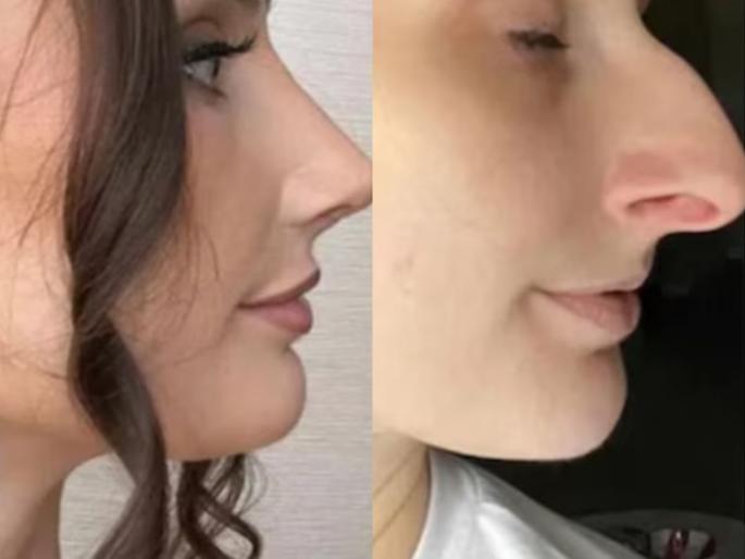 wife divorces husband after he undergoes nose surgery for rs 9 lakh | अगं बाई अरेच्चा! नाकाची केली ९ लाखांची सर्जरी; सुंदर दिसताच बायकोने दिला घटस्फोट, म्हणाली... wife divorces husband after he undergoes nose surgery for rs 9 lakh | अगं बाई अरेच्चा! नाकाची केली ९ लाखांची सर्जरी; सुंदर दिसताच बायकोने दिला घटस्फोट, म्हणाली...