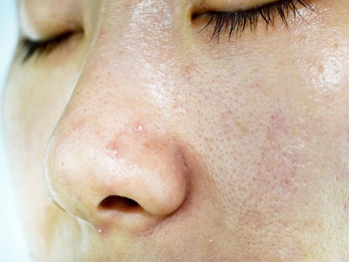 Oily and acne prone skinface packs for oily skin | तेलकट त्वचेमुळे हैराण आहात?; मग 'हे' फेसपॅक नक्की ट्राय करा! Oily and acne prone skinface packs for oily skin | तेलकट त्वचेमुळे हैराण आहात?; मग 'हे' फेसपॅक नक्की ट्राय करा!