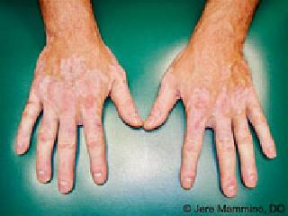 White stains are not leprosy | पांढरा डाग म्हणजे कुष्ठरोग नाही