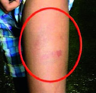 On the other hand, a private teacher was assaulted by a teacher | वरळीत खासगी शिक्षकेकडून विद्यार्थ्याला बेदम मारहाण