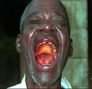 Global Emergency with Ebola | इबोलाची साथ जागतिक आणीबाणी