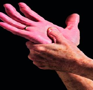 Elderhood is known for rheumatism! | तरुणाई संधिवाताच्या विळख्यात! Elderhood is known for rheumatism! | तरुणाई संधिवाताच्या विळख्यात!