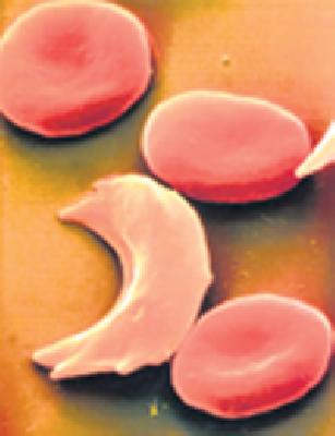 Special blood supply to patients with sickle-thalassemia | सिकलसेल-थॅलेसेमियाच्या रुग्णांना विशेष रक्तपुरवठा