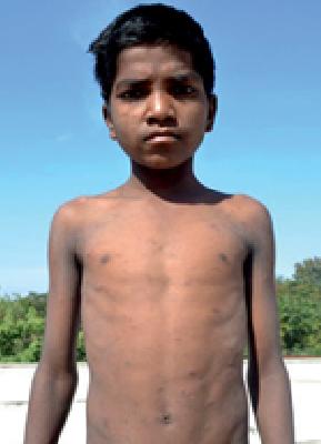 Students of the Amravati Ashramshala can not be killed | अमरावतीच्या आश्रमशाळेत विद्यार्थ्यांना नरकयातना