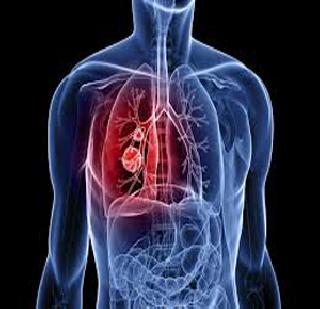 Due to the tragedy of most of the victims of cancer | कर्करोगाचे बहुतांश बळी दुर्दैवामुळे