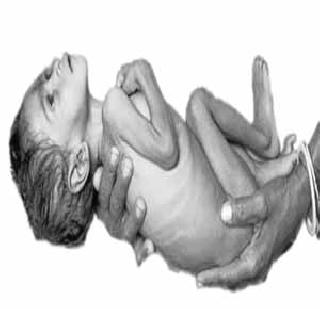 869 children of malnourished children in Bhiwandi rural | भिवंडी ग्रामीणमध्ये ८६९ बालके कुपोषित