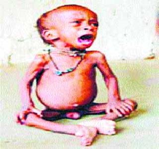 Forecasting of malnutrition continued | कुपोषणाचा विळखा कायम Forecasting of malnutrition continued | कुपोषणाचा विळखा कायम