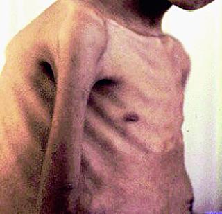 Trouble of Tuberculosis | क्षयरोगाच्या औषधांचा तुटवडा Trouble of Tuberculosis | क्षयरोगाच्या औषधांचा तुटवडा