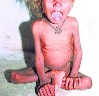 Absence of malnutrition! | कुपोषण निर्मूलनाची अजब तऱ्हा !