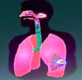 Free treatment for tuberculosis in private hospitals | खासगी रुग्णालयात क्षयरोगावर मोफत उपचार