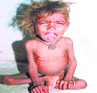 The first malnutrition in the country is in outpatient department Sion | देशातील पहिला कुपोषण बाह्यरुग्ण विभाग सायनमध्ये The first malnutrition in the country is in outpatient department Sion | देशातील पहिला कुपोषण बाह्यरुग्ण विभाग सायनमध्ये