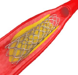 Announce Stant as a Vital Need - FDA report | स्टेण्टला जीवनावश्यक औषध म्हणून जाहीर करा -एफडीएचा अहवाल