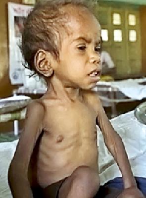 518 children report malnutrition | ५१८ बालके कुपोषणाच्या विळख्यात