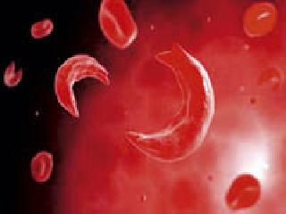 Death toll | सिकलसेलग्रस्तांना मरणयातना