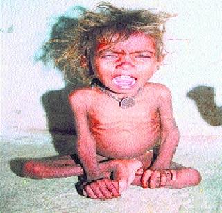 54 children report malnutrition | ५४ बालके कुपोषणाच्या विळख्यात