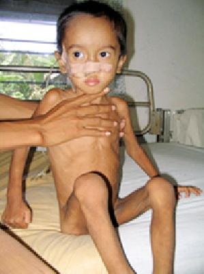 Two child treatment centers for malnutrition | कुपोषणमुक्तीसाठी दोन बाल उपचार केंद्र