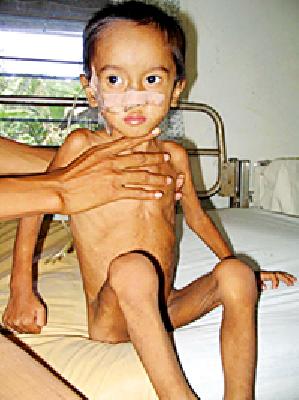 Malnutrition ratio decreasing in the district | जिल्ह्यात घटतेय कुपोषणाचे प्रमाण