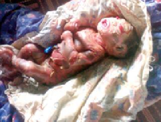 'Harquilin' was born baby | ‘हरक्विलीन’ग्रस्त बाळ जन्मले 'Harquilin' was born baby | ‘हरक्विलीन’ग्रस्त बाळ जन्मले