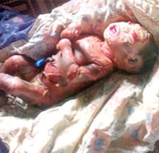 Child born in Gadchiroli district | गडचिरोलीत हरक्विलीनग्रस्त जन्मले बाळ Child born in Gadchiroli district | गडचिरोलीत हरक्विलीनग्रस्त जन्मले बाळ