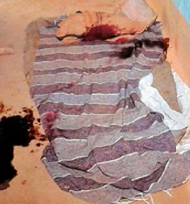 Kurkhed assault on social worker | कुरखेड्यात सामाजिक कार्यकर्त्यावर प्राणघातक हल्ला Kurkhed assault on social worker | कुरखेड्यात सामाजिक कार्यकर्त्यावर प्राणघातक हल्ला