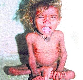 Government scrutiny on malnutrition question | कुपोषणाच्या प्रश्नावर शासन ढिम्मच Government scrutiny on malnutrition question | कुपोषणाच्या प्रश्नावर शासन ढिम्मच