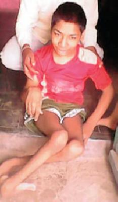 Umesh Sansota unbearable pain for the disabled! | अपंगत्वापायी उमेश सोसतोय असह्य वेदना!