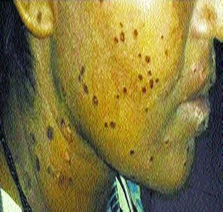 Incident burns given to the woman to improve mental health | मानसिक आरोग्य सुधारण्यासाठी महिलेला दिले अगरबत्तीचे चटके Incident burns given to the woman to improve mental health | मानसिक आरोग्य सुधारण्यासाठी महिलेला दिले अगरबत्तीचे चटके