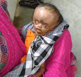 Prosecutor suspect found in Aheri taluka | अहेरी तालुक्यात आढळला प्रोजेरियाचा संशयित रूग्ण