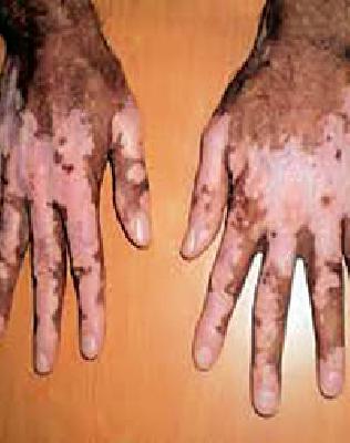 Five thousand 9 9 suspected cases of leprosy | कुष्ठरोगाचे पाच हजार ९८९ संशयित रुग्ण