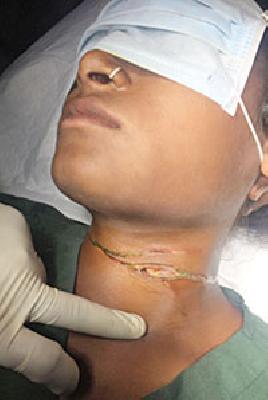 The scratched the throats | मांजाने गळा कापला