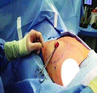 Breast Cancer for the third person in the same family | एकाच कुटुंबातील तिसऱ्या पुरुषाला स्तनाचा कर्करोग Breast Cancer for the third person in the same family | एकाच कुटुंबातील तिसऱ्या पुरुषाला स्तनाचा कर्करोग