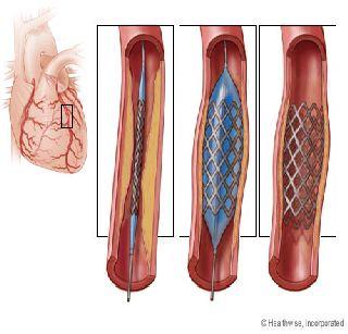 Action taken after scarcity of stents | स्टेंट्सची टंचाई केल्यास कारवाई