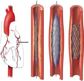 Report if 'stent' is not available | ‘स्टेंट’ उपलब्ध होत नसल्यास तक्रार करा Report if 'stent' is not available | ‘स्टेंट’ उपलब्ध होत नसल्यास तक्रार करा