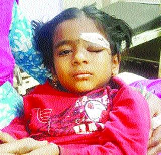 The dog's cheeks saved the eye of happiness | कुत्र्याच्या चाव्यातून खुशीचा डोळा बचावला The dog's cheeks saved the eye of happiness | कुत्र्याच्या चाव्यातून खुशीचा डोळा बचावला