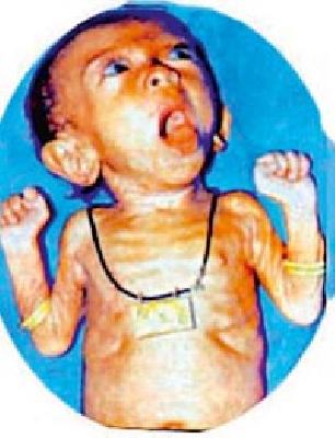 Adoption of Chandrapur Zilla Parishad's malnourished children | चंद्रपूर जिल्हा परिषद कुपोषित बालकांना घेणार दत्तक