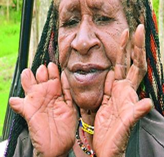 After the death of the head of the family, | कुटुंबप्रमुखाच्या मृत्यूनंतर महिलांची बोटे छाटण्याची प्रथा After the death of the head of the family, | कुटुंबप्रमुखाच्या मृत्यूनंतर महिलांची बोटे छाटण्याची प्रथा