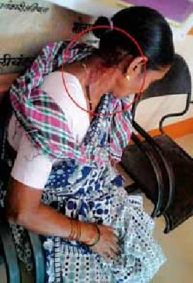 Women injured in Monkey attack | माकडांच्या हल्ल्यात महिला जखमी Women injured in Monkey attack | माकडांच्या हल्ल्यात महिला जखमी