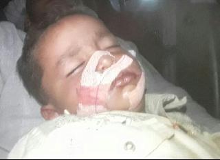 Six dogs of Akoleat bite, six of them have serious health | अकोलेत पिसाळलेल्या कुत्र्याचा सहा जणांना चावा, २ बालकांची प्रकृती गंभीर Six dogs of Akoleat bite, six of them have serious health | अकोलेत पिसाळलेल्या कुत्र्याचा सहा जणांना चावा, २ बालकांची प्रकृती गंभीर