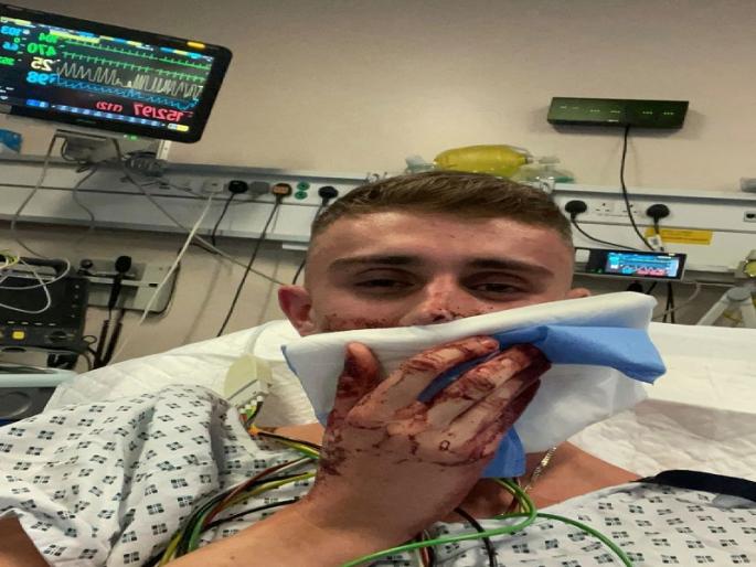 After returning from the Tokyo Olympics, jack woolley of ireland beaten, several stitches on face | टोकियो ऑलिम्पिकवरुन परतल्यानंतर खेळाडूला बेदम मारहाण, चेहऱ्यावर पडले अनेक टाके After returning from the Tokyo Olympics, jack woolley of ireland beaten, several stitches on face | टोकियो ऑलिम्पिकवरुन परतल्यानंतर खेळाडूला बेदम मारहाण, चेहऱ्यावर पडले अनेक टाके