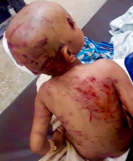 A bumpy dog bumped in a tamarind; Excitement in Saiful area | शेतात पाण्यासाठी गेलेल्या चिमुकल्यावर तुटून पडली मोकाट कुत्री; सैफुल परिसरात खळबळ A bumpy dog bumped in a tamarind; Excitement in Saiful area | शेतात पाण्यासाठी गेलेल्या चिमुकल्यावर तुटून पडली मोकाट कुत्री; सैफुल परिसरात खळबळ