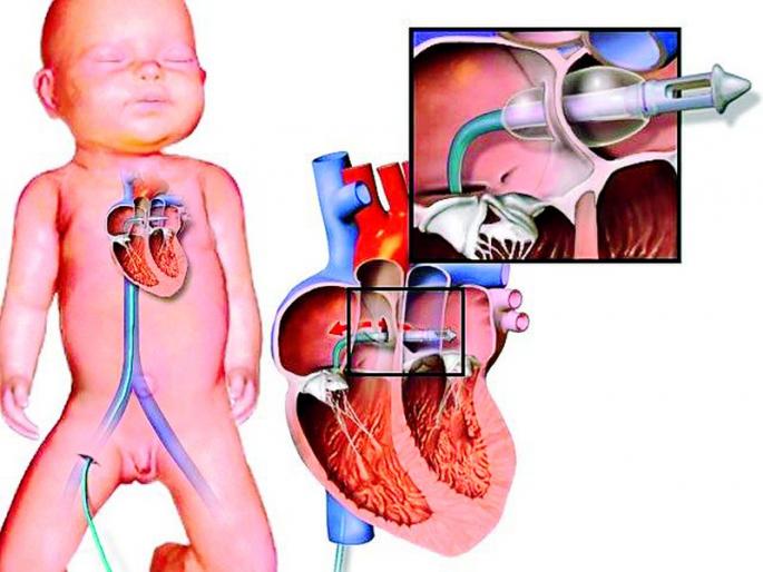 One month old infant survives in Nagpur | नागपुरात एक महिन्याच्या नवजात शिशूचे वाचले प्राण One month old infant survives in Nagpur | नागपुरात एक महिन्याच्या नवजात शिशूचे वाचले प्राण