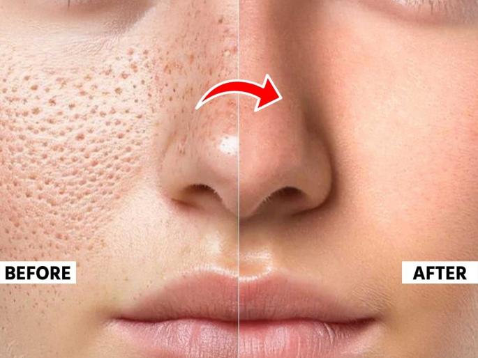 Open pores make the face look ugly, do 5 things every day - effective treatment for open pores | ओपन पोर्समुळे चेहरा तर विद्रूप दिसतोच, रोज करा ५ गोष्टी-ओपनसोर्सवर प्रभावी इलाज